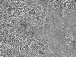 We are giving the wrong figures to the world. Portal Hypertension Secondary To Isolated Liver Tuberculosis In The American Journal Of Tropical Medicine And Hygiene Volume 87 Issue 1 2012
