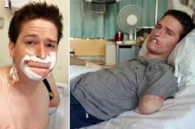 Septicemia And Toxic Shock Syndrome: Alex lost all four limbs and his lips 