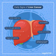 Each year in the united states, about 24,500 men and 10,000 women get liver cancer, and about 18,600 men and 9 what are the symptoms of liver cancer? Stages Of Liver Cancer What Happens In Stages 1 4
