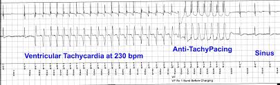 A cardiac pacemaker (or artificial pacemaker, so as not to be confused with the natural pacemaker of the heart), is a medical device that generates electrical impulses delivered by electrodes to cause the heart muscle chambers. The Positive Side Of Implantable Cardiac Devices