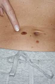 Learn how each type differs. Basal Cell Carcinoma Faqs Long Beach Ca Skin Cancer Treatment Ca
