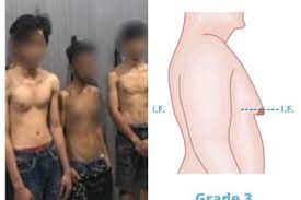 Berbeda dengan yang jantan, payudara mamalia betina memiliki kelenjar susu yang berfungsi untuk memompa susu bagi bayinya. Beredar Foto Pria Diduga Maling Punya Payudara Seperti Perempuan Ternyata Ginekomastia Semua Halaman Nakita