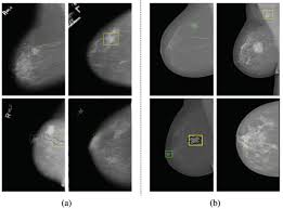 Image result for Mammogram Interpretation