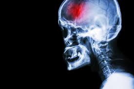 An essay conclusion is the next most important part after the introduction. Stroke Rehabilitation