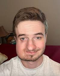 Conoce la historia de Lukas y su lucha con el síndrome de Parry-Romberg