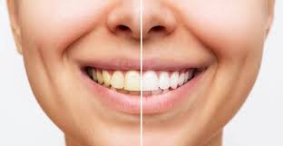 Can Whitening Teeth Damage Enamel? - Caldwell, Bills, Petrilli & West