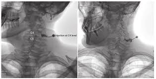 Jcm Free Full Text Fluoroscopic Findings Of Extra Cervical Facet Joint Flow And Its Incidence On Cervical Facet Joint Arthrograms