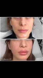 Facebeautification …