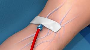 Image result for Blood Transfusion