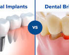 Dental Implants vs. Bridges: Finding What's Best for You | Dr ...