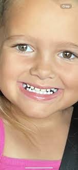 why is everybody side tooth missing should i take mines out?