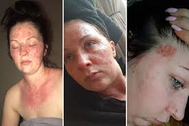 But all products that get rid of black hair dye do damage your hair. Mum Of One Left Scarred From Severe Burns After Suffering Allergic Reaction To Hair Dye Thejjreport