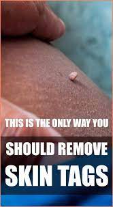 This Is The Only Way You Should Remove Skin Tags According To A Dermatologist Skin Tags Home Remedies Skin Tag Removal Skin Tag