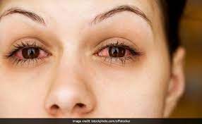 Maybe you would like to learn more about one of these? Allergic Conjunctivitis On The Rise 6 Best Home Remedies