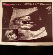 Anyone Else Find Out Gender At 17 Weeks Nbsp December 2017 Babies Forums What To Expect