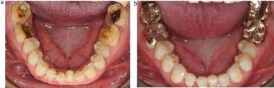 Image result for Tooth Attrition