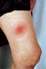 Lyme Disease Infectious Diseases Msd Manual Professional Edition