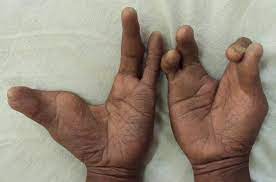 Ectrodactyly Ectodermal Dysplasia And Cleft Lip Palate Eec Syndrome Without Clefting A Rare Case Report