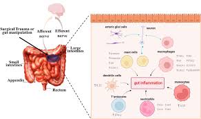 Image result for Adynamic Ileus