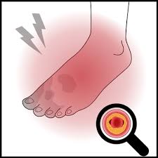 Pavk Symptome Stadien Risikofaktoren Ratgeber Cholesterin