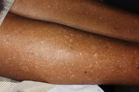 Idiopathic Guttate Hypomelanosis | School of Medicine