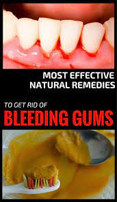 Most Effective Natural Remedies To Get Rid Of Bleeding Gums All Beauty Tips For Women Gum Disease Treatment Gum Care Healthy Teeth