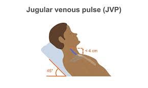 Image result for Venous Tap Test