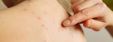 Wie sieht es aber mit windpocken gerade wegen windpocken im zusammenhang mit der impfung sind in der regel harmlos und beeinträchtigen. Faqs Haufig Gestellte Fragen Zu Windpocken Varizellen Rxlist Faqs