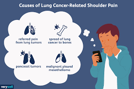 But it's not clear how useful these tests are in finding mesotheliomas … When Might Shoulder Pain Be A Sign Of Lung Cancer Or Mesothelioma