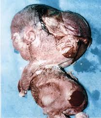 The health effects of uranium have been studied extensively for more than 50 years. Depleted Uranium Cause And Effect 4 Hour Special On The A Xa Zone Radio Show And Talkstar Radio Network