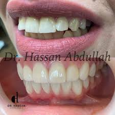 Dr Hassan Dental Clinic عيادة الدكتور حس ان عبدالله طبيب لب أسنان عمان فيسبوك ٦٩ صورة
