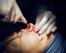 Your Guide To Rhinoplasty From Cost To Recovery Time Life In Plastic Allure