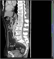 Https Casereports Bmj Com Content 2016 Bcr 2016 217111 Full Pdf
