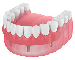 Is $34,000 for a full set of implants. My Implant Denture Doesn T Fit Right Bayou Dental Group