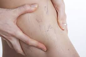 Your doctor may also ask you to describe any pain and aching in. 9 Things You Need To Know About Varicose And Spider Veins