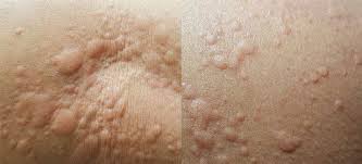 Sometimes a rash may develop without direct contact with the plant; What Rash Is This Which