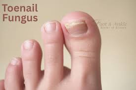 Image result for Onycholysis feet