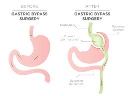 roux en y gastric byp surgery and
