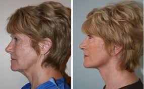 Maybe you would like to learn more about one of these? Facelift Necklift London Plastic Surgeon Baaps Council Member