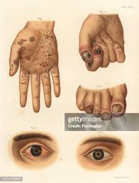 Image result for syphilis symptoms