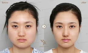 25 Korean plastic surgery ideas