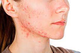Do Food Sensitivities And Allergies Cause Acne Natural Acne Clinic