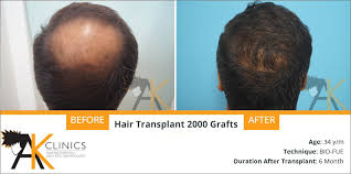 Olaplex's patented active chemistry works on a molecular level to repair damaged and broken bonds in the hair. Success Story 2000 Grafts Hair Transplant Surgery Result After 6 Months Ak Clinics