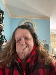 I'm Chelsea my kids and I have NF Type 1 I'm from New Franken Wisconsin and  now live in Green Bay Wisconsin