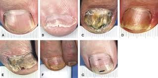 Image result for onychomycosis