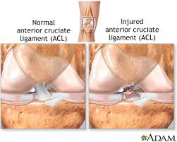 In most cases rehabilitative exercises for patients with ligame. Anterior Cruciate Ligament Acl Injury Medlineplus Medical Encyclopedia