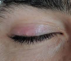 For a sty that persists, your doctor may recommend treatments, such as: What Is A Stye How Do I Cure It Safely Lasikplus