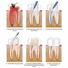 Root Canal Treatment Cm Dental Cinic Chiang Mai