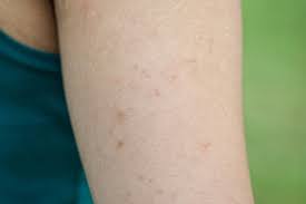 Got Red Itchy Bumps That Never Go Away Use These Dermatologist Approved Treatments To Smooth Them Over Once And Fo Chicken Skin Keratosis Pilaris Skin Bumps