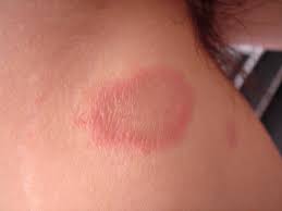 Was hilft bei trichodynie, juckender kopfhaut und schmerzen auf dem kopf? Pityriasis Rosea Deximed
